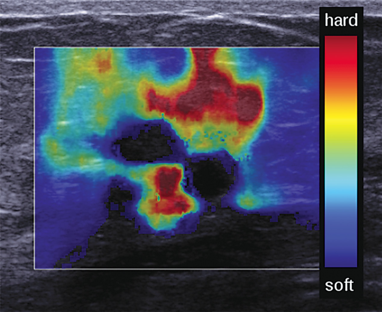 Noncalcified grade 1 cribriform DCIS
